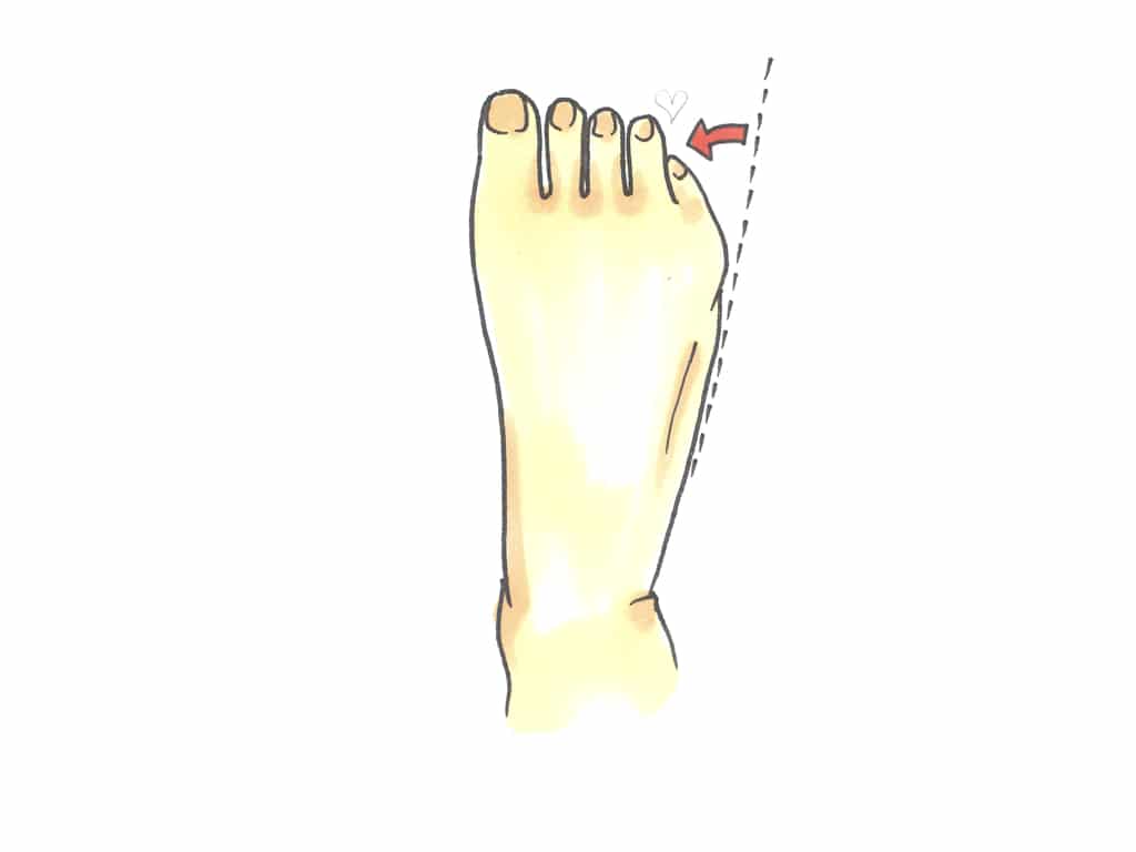 内反小趾の絵