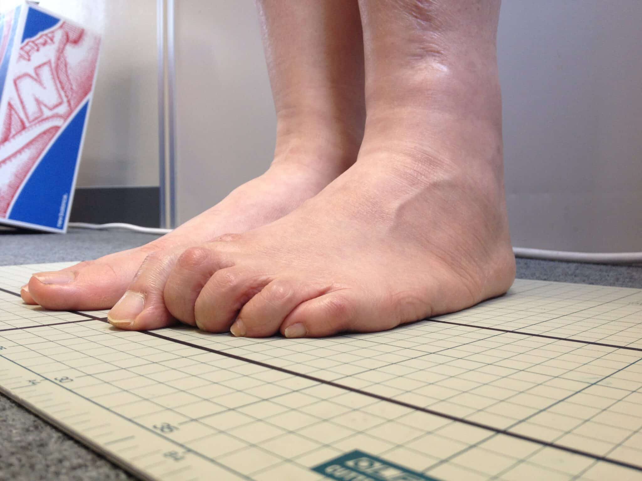 かがみ指の治し方 足指体操と魔法のくつ下の驚くべき効果 足指研究所