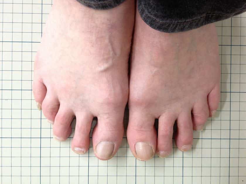 外反母趾の治し方 足指体操と魔法の靴下の驚くべき効果 足指研究所