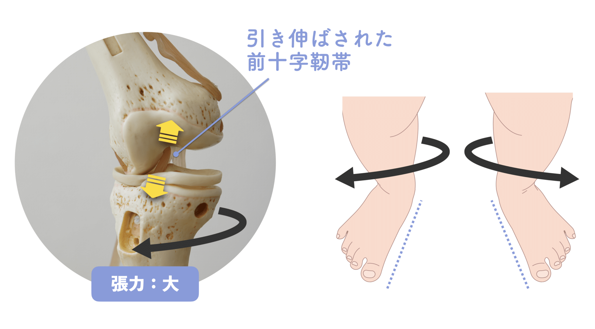 【医療監修】前十字靭帯損傷を“何度も繰り返す人”へ|本当の原因は膝ではなく“足指の機能低下”かも? | 湯浅慶朗【公式】足指研究所