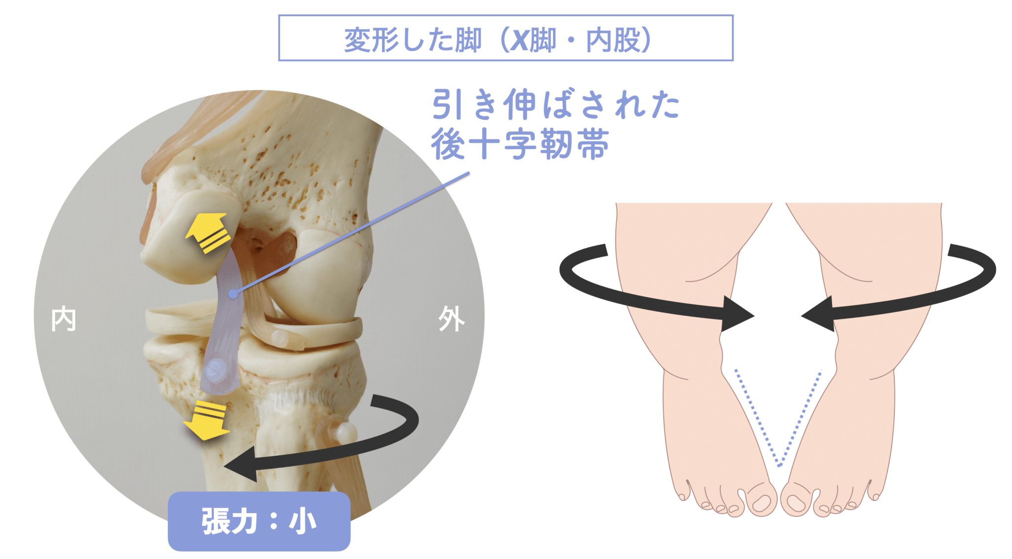 後 十字 靭帯 損傷 完治 期間