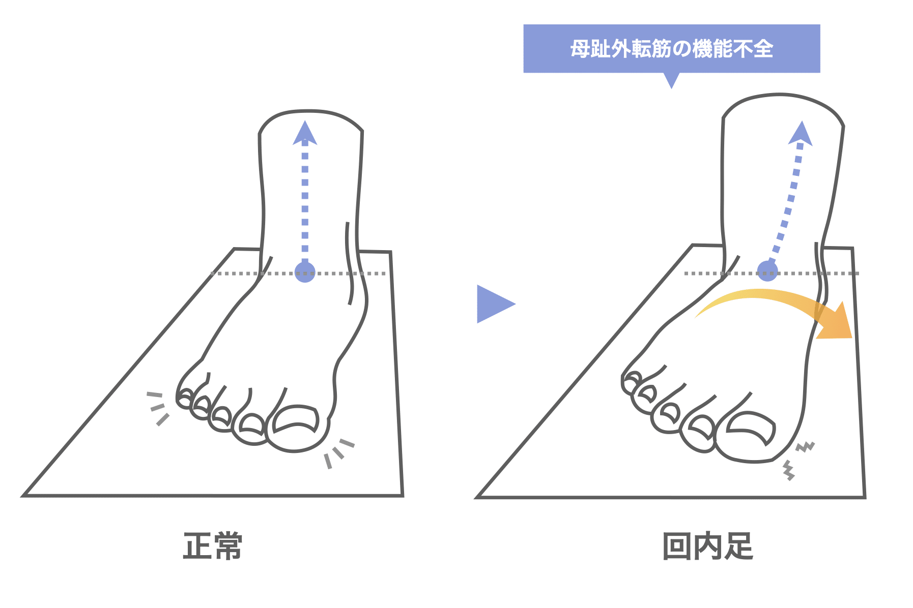 母 趾 外 転 筋