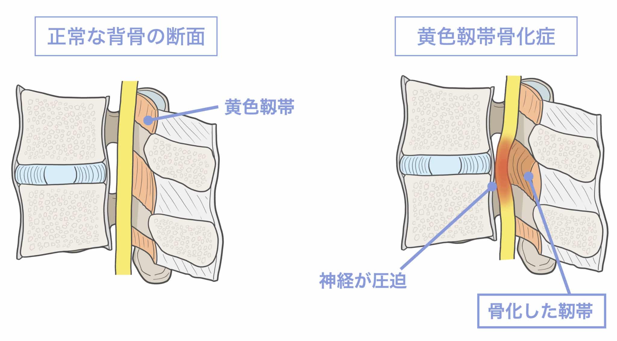 黄色 靱帯 骨 化 症