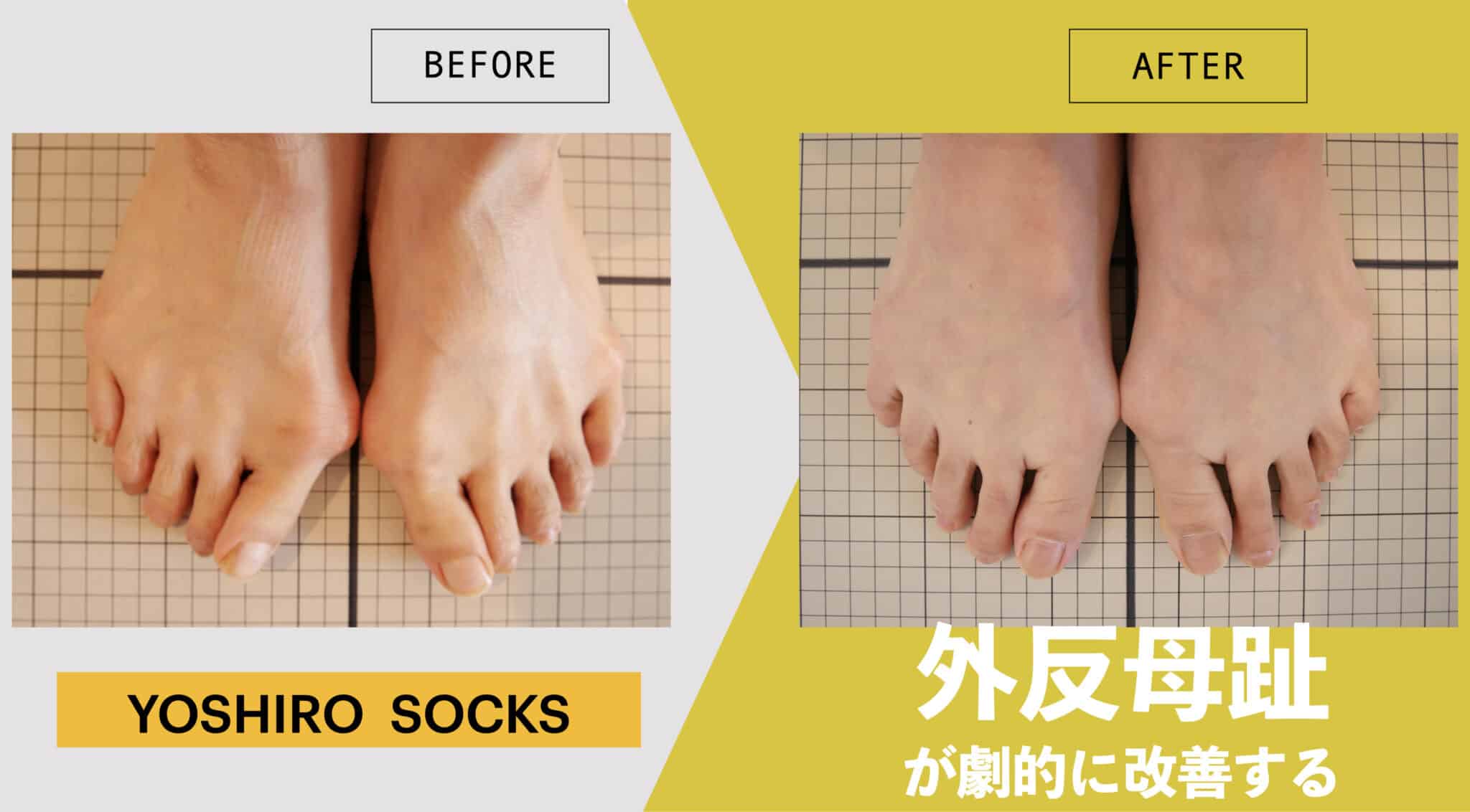 足指を広げて外反母趾角が劇的改善！YOSHIRO SOCKSで6ヶ月間で平均15.4 