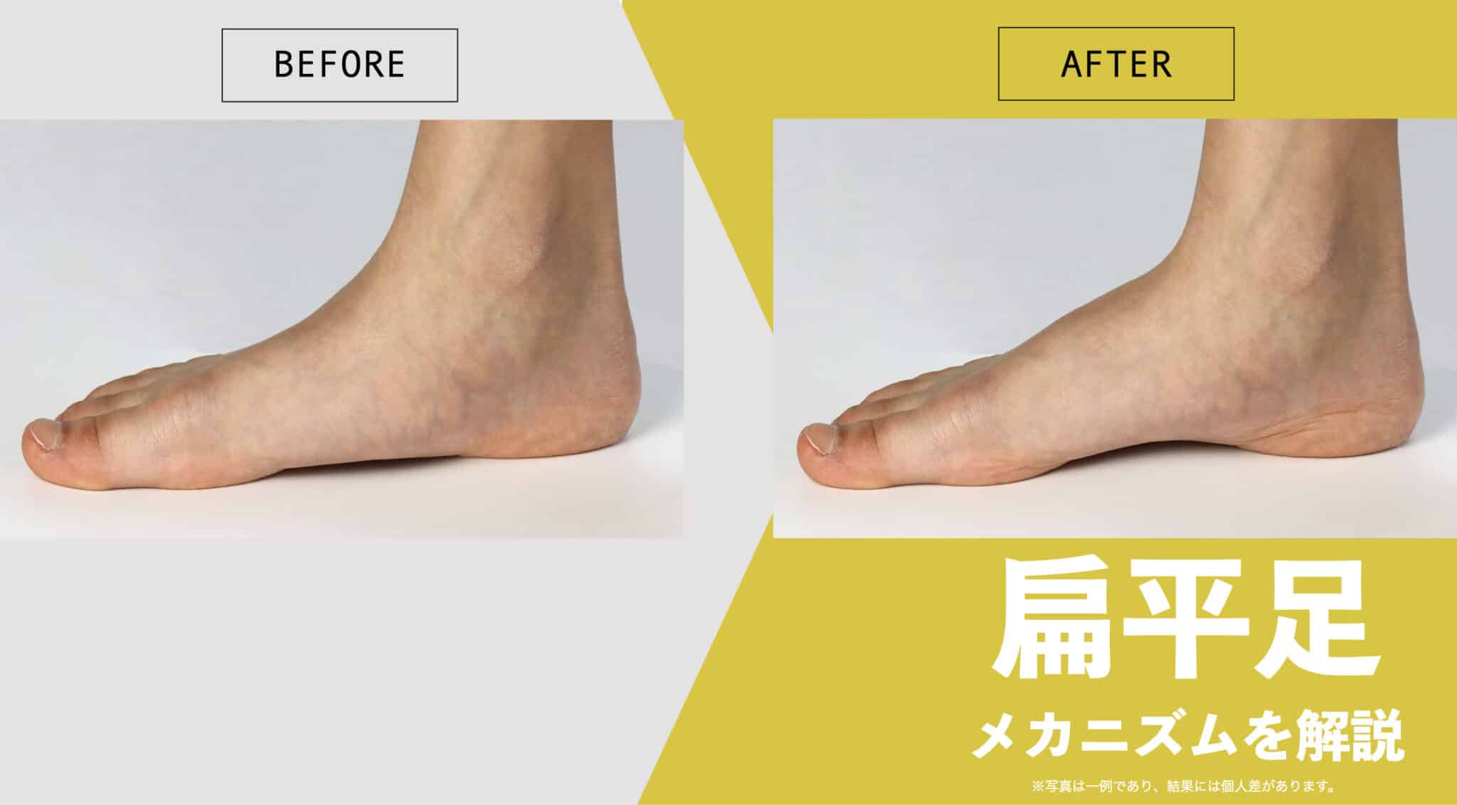 扁平足 と は